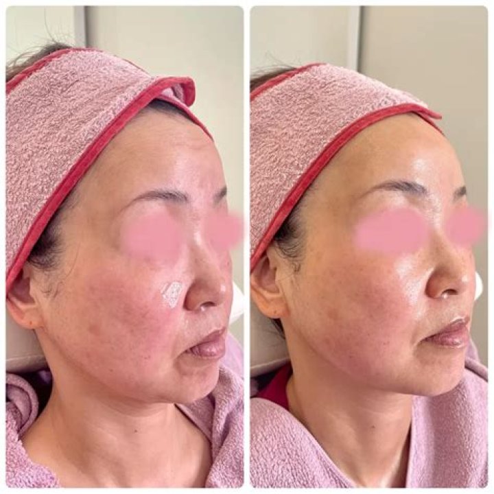 beforeafter